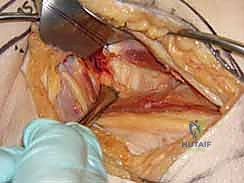 صورة طبية: كسر عنق الفخذ: العلاج الحديث بالمسامير المجوفة عبر الجلد مع الأستاذ الدكتور محمد هطيف في صنعاء