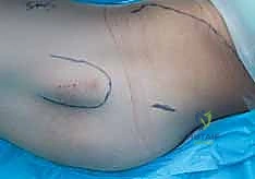 صورة طبية: كسر عنق الفخذ: العلاج الحديث بالمسامير المجوفة عبر الجلد مع الأستاذ الدكتور محمد هطيف في صنعاء