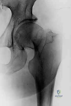 صورة طبية: كسر عنق الفخذ: العلاج الحديث بالمسامير المجوفة عبر الجلد مع الأستاذ الدكتور محمد هطيف في صنعاء