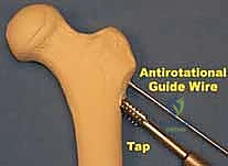 صورة طبية: كسر عنق الفخذ: العلاج الحديث بالمسامير المجوفة عبر الجلد مع الأستاذ الدكتور محمد هطيف في صنعاء