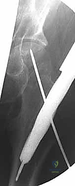 صورة توضيحية لـ كسر عنق الفخذ: العلاج الحديث بالمسامير المجوفة عبر الجلد مع الأستاذ الدكتور محمد هطيف في صنعاء