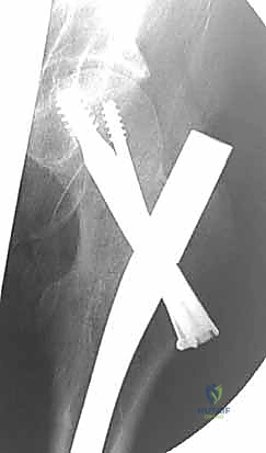 صورة طبية: كسر عنق الفخذ: العلاج الحديث بالمسامير المجوفة عبر الجلد مع الأستاذ الدكتور محمد هطيف في صنعاء