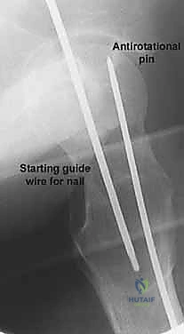 صورة توضيحية لـ كسر عنق الفخذ: العلاج الحديث بالمسامير المجوفة عبر الجلد مع الأستاذ الدكتور محمد هطيف في صنعاء