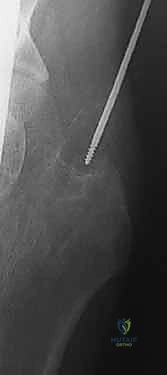 صورة طبية: كسر عنق الفخذ: العلاج الحديث بالمسامير المجوفة عبر الجلد مع الأستاذ الدكتور محمد هطيف في صنعاء