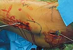 صورة توضيحية لـ كسر عنق الفخذ: العلاج الحديث بالمسامير المجوفة عبر الجلد مع الأستاذ الدكتور محمد هطيف في صنعاء