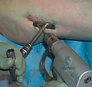 صورة توضيحية لـ كسر عنق الفخذ: العلاج الحديث بالمسامير المجوفة عبر الجلد مع الأستاذ الدكتور محمد هطيف في صنعاء