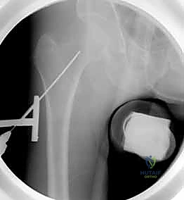 صورة توضيحية لـ كسر عنق الفخذ: العلاج الحديث بالمسامير المجوفة عبر الجلد مع الأستاذ الدكتور محمد هطيف في صنعاء