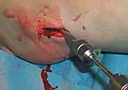 صورة طبية: كسر عنق الفخذ: العلاج الحديث بالمسامير المجوفة عبر الجلد مع الأستاذ الدكتور محمد هطيف في صنعاء