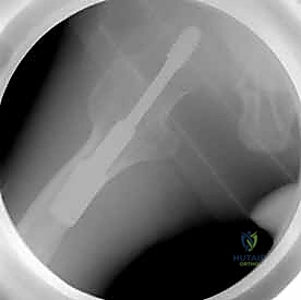 صورة توضيحية لـ كسر عنق الفخذ: العلاج الحديث بالمسامير المجوفة عبر الجلد مع الأستاذ الدكتور محمد هطيف في صنعاء
