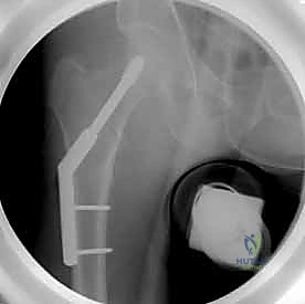 نموذج ثلاثي الأبعاد يوضح مسار المسامير