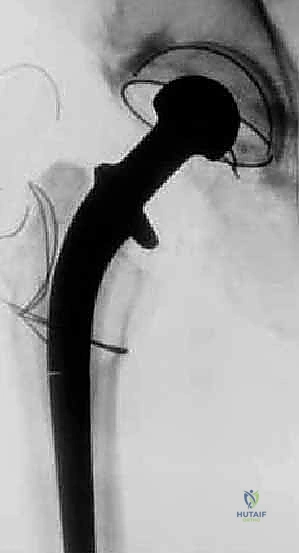 صورة توضيحية لـ إتقان جراحة مراجعة استبدال مفصل الورك: دليل شامل لإزالة المكونات الثابتة بإحكام