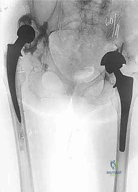 تشريح مفصل الورك والأعصاب المحيطة في جراحات المراجعة
