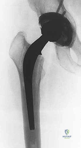 توضيح الأوعية الدموية حول مفصل الورك