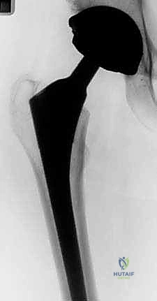 العضلات الألوية وأهميتها في استقرار المفصل