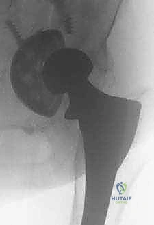 التشريح العظمي للحوض وعظم الفخذ