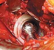 التآكل العظمي حول مفصل الورك الصناعي