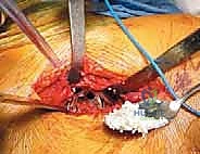 كسر حول مفصل الورك الصناعي