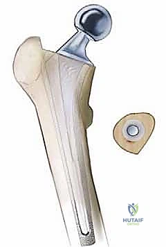 صورة طبية: إتقان جراحة مراجعة استبدال مفصل الورك: دليل شامل لإزالة المكونات الثابتة بإحكام