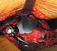 التصوير الإشعاعي لتقييم مفصل الورك قبل المراجعة