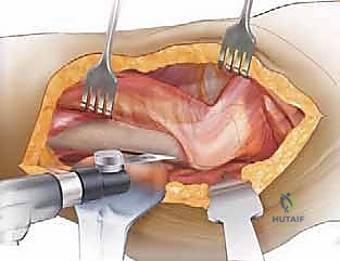 إتقان جراحة مراجعة استبدال مفصل الورك: دليل شامل لإزالة المكونات الثابتة بإحكام