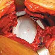 التخطيط الرقمي قبل جراحة مراجعة الورك