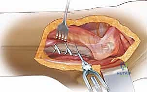 صورة طبية: إتقان جراحة مراجعة استبدال مفصل الورك: دليل شامل لإزالة المكونات الثابتة بإحكام