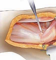 صورة توضيحية لـ إتقان جراحة مراجعة استبدال مفصل الورك: دليل شامل لإزالة المكونات الثابتة بإحكام
