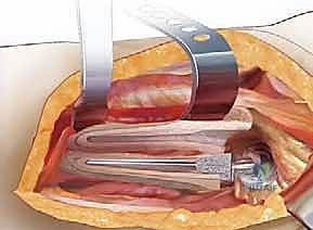 صورة توضيحية لـ إتقان جراحة مراجعة استبدال مفصل الورك: دليل شامل لإزالة المكونات الثابتة بإحكام