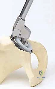 صورة توضيحية لـ إتقان جراحة مراجعة استبدال مفصل الورك: دليل شامل لإزالة المكونات الثابتة بإحكام