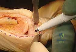 عوامل الخطر والأسباب المؤدية لتشوه إبهام القدم