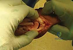 التشخيص الإشعاعي لتشوه إبهام القدم الأروح