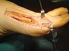 صورة توضيحية لـ قطع عظم أكين: الحل الدقيق لإبهام القدم الأروح بين السلاميات على يد الأستاذ الدكتور محمد هطيف