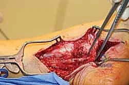 مسار العصب الصافن والشظوي في الطرف السفلي