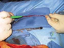 الأسباب الشائعة لالتهاب الأعصاب الالتصاقي بعد الجراحة