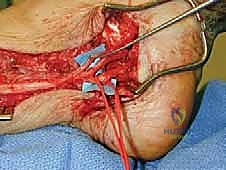 التهاب الأعصاب الالتصاقي: الأسباب، الأعراض، والعلاج المتقدم في صنعاء مع الأستاذ الدكتور محمد هطيف