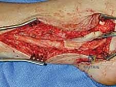 Surgical technique step for Barrier Procedures for Adhesive Neuralgia