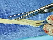 صورة توضيحية لـ التهاب الأعصاب الالتصاقي: الأسباب، الأعراض، والعلاج المتقدم في صنعاء مع الأستاذ الدكتور محمد هطيف