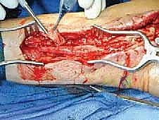 صورة توضيحية لـ التهاب الأعصاب الالتصاقي: الأسباب، الأعراض، والعلاج المتقدم في صنعاء مع الأستاذ الدكتور محمد هطيف