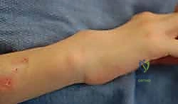 صورة توضيحية لـ استئصال الغشاء الزليلي للأوتار القابضة والباسطة في اليد: دليل شامل للمرضى مع الأستاذ الدكتور محمد هطيف