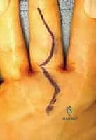 صورة توضيحية لـ استئصال الغشاء الزليلي للأوتار القابضة والباسطة في اليد: دليل شامل للمرضى مع الأستاذ الدكتور محمد هطيف