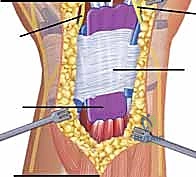 صورة طبية: استئصال الغشاء الزليلي للأوتار القابضة والباسطة في اليد: دليل شامل للمرضى مع الأستاذ الدكتور محمد هطيف