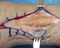 العلاج التحفظي والجبائر لالتهاب الأوتار