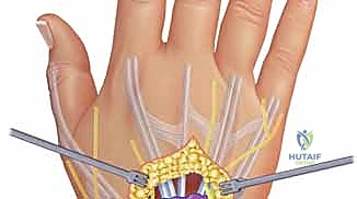 صورة توضيحية لـ استئصال الغشاء الزليلي للأوتار القابضة والباسطة في اليد: دليل شامل للمرضى مع الأستاذ الدكتور محمد هطيف