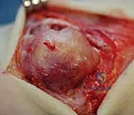 صورة توضيحية لـ استئصال الغشاء الزليلي للأوتار القابضة والباسطة في اليد: دليل شامل للمرضى مع الأستاذ الدكتور محمد هطيف