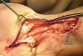 Surgical technique step for Flexor and Extensor Tenosynovectomy