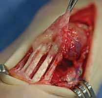 صورة طبية: استئصال الغشاء الزليلي للأوتار القابضة والباسطة في اليد: دليل شامل للمرضى مع الأستاذ الدكتور محمد هطيف