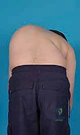 صورة توضيحية لتشوه الجنف ثلاثي الأبعاد