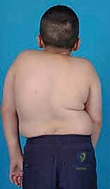 صورة توضيحية لـ جراحة تحرير ودمج الجنف الأمامي بالمنظار الصدري: دليل شامل للمرضى