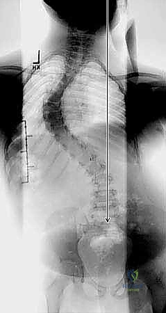 تشريح العمود الفقري الصدري والأقراص