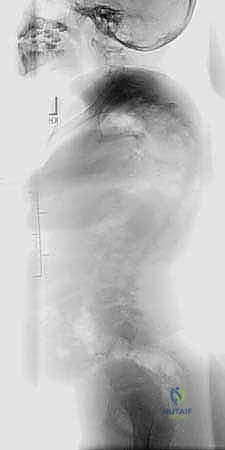 التشريح الدقيق للأربطة والأوعية الدموية في الصدر
